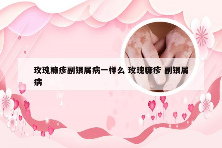 玫瑰糠疹副银屑病一样么 玫瑰糠疹 副银屑病