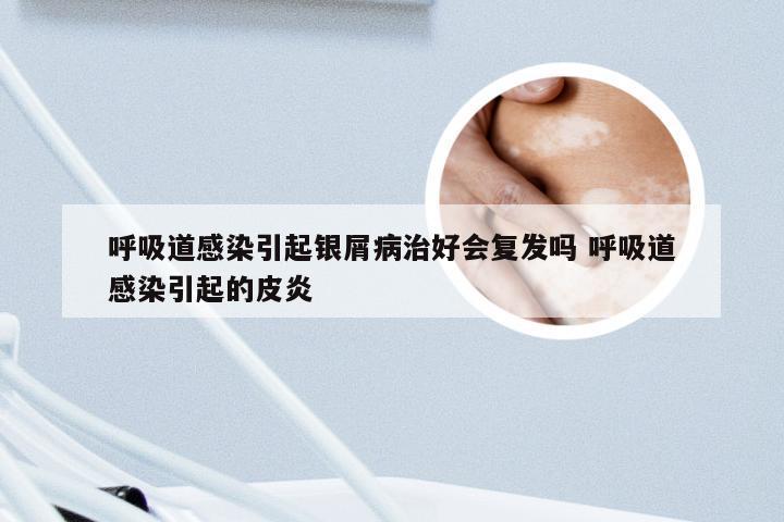 呼吸道感染引起银屑病治好会复发吗 呼吸道感染引起的皮炎
