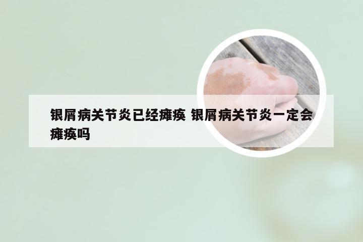 银屑病关节炎已经瘫痪 银屑病关节炎一定会瘫痪吗