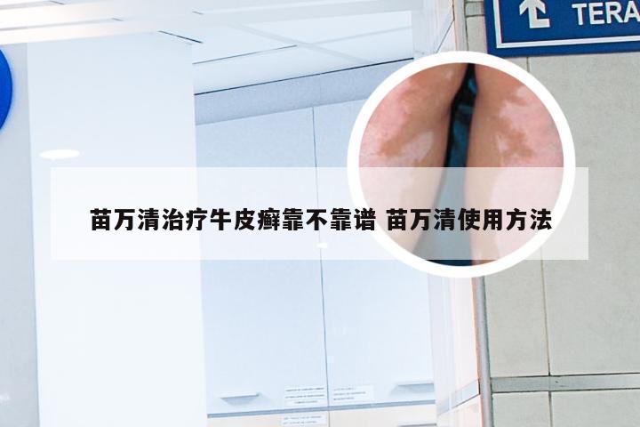 苗万清治疗牛皮癣靠不靠谱 苗万清使用方法