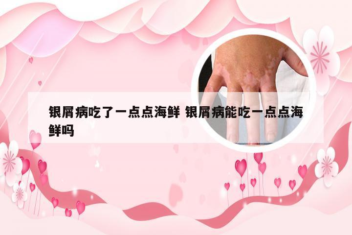 银屑病吃了一点点海鲜 银屑病能吃一点点海鲜吗
