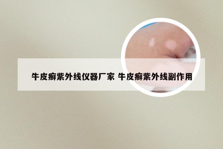 牛皮癣紫外线仪器厂家 牛皮癣紫外线副作用