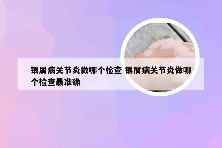 银屑病关节炎做哪个检查 银屑病关节炎做哪个检查最准确