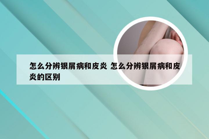 怎么分辨银屑病和皮炎 怎么分辨银屑病和皮炎的区别
