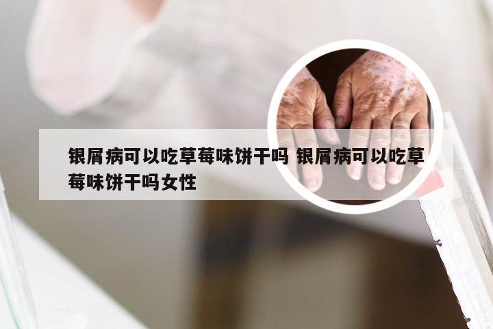 银屑病可以吃草莓味饼干吗 银屑病可以吃草莓味饼干吗女性