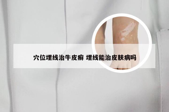穴位埋线治牛皮癣 埋线能治皮肤病吗