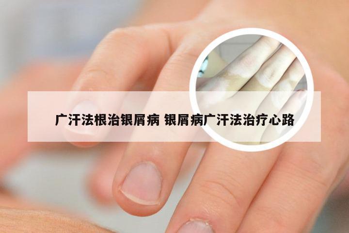 广汗法根治银屑病 银屑病广汗法治疗心路