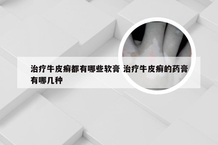 治疗牛皮癣都有哪些软膏 治疗牛皮癣的药膏有哪几种