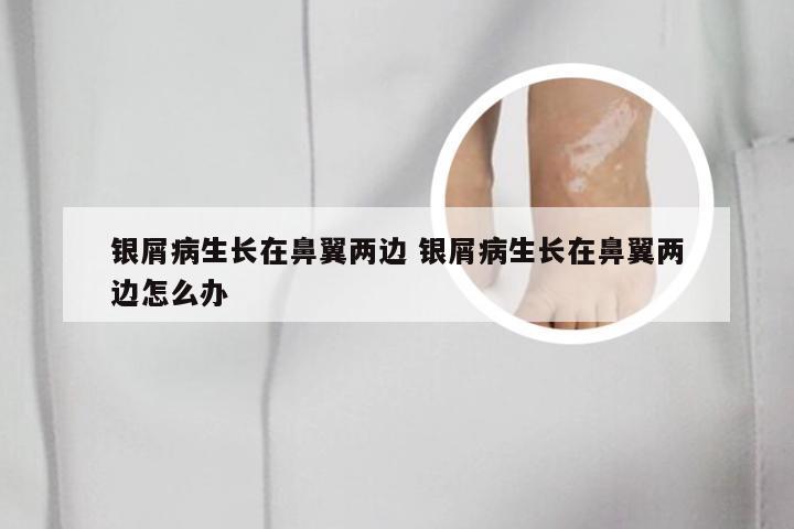 银屑病生长在鼻翼两边 银屑病生长在鼻翼两边怎么办