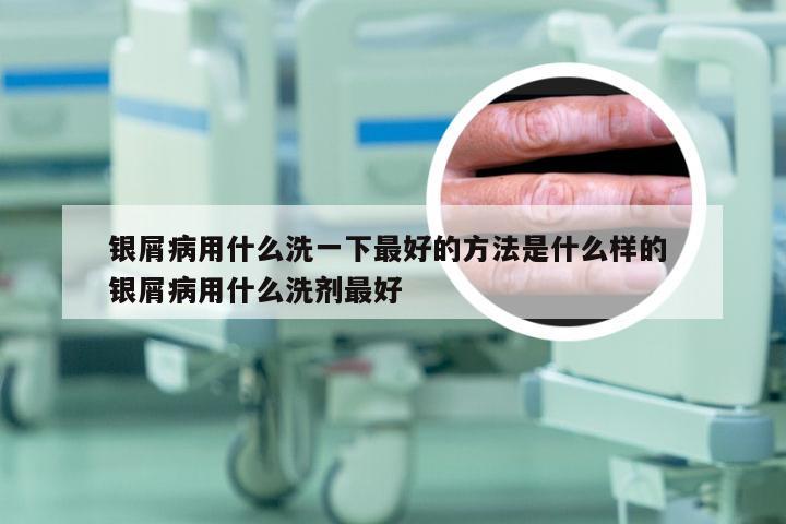 银屑病用什么洗一下最好的方法是什么样的 银屑病用什么洗剂最好