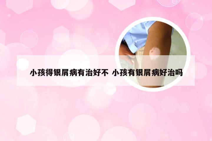 小孩得银屑病有治好不 小孩有银屑病好治吗