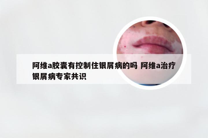 阿维a胶囊有控制住银屑病的吗 阿维a治疗银屑病专家共识