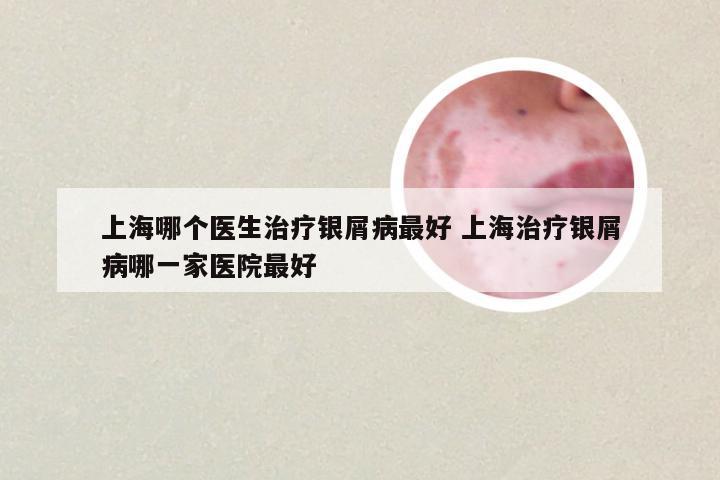 上海哪个医生治疗银屑病最好 上海治疗银屑病哪一家医院最好