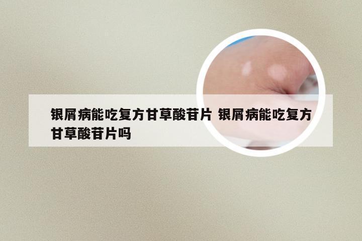 银屑病能吃复方甘草酸苷片 银屑病能吃复方甘草酸苷片吗