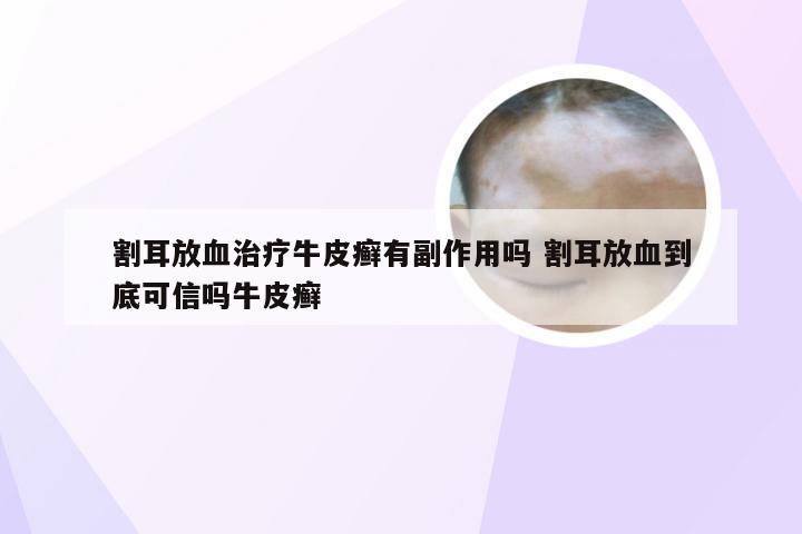 割耳放血治疗牛皮癣有副作用吗 割耳放血到底可信吗牛皮癣