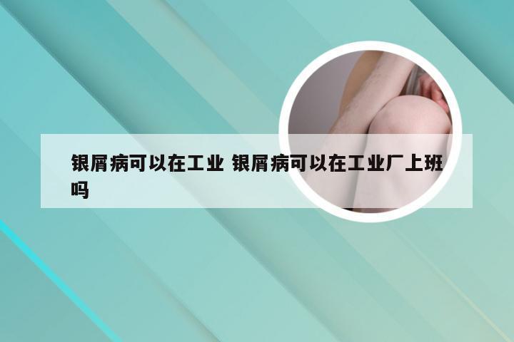 银屑病可以在工业 银屑病可以在工业厂上班吗
