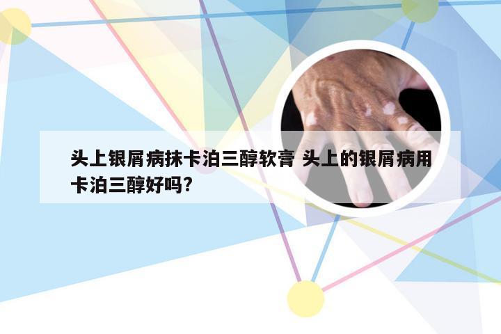 头上银屑病抹卡泊三醇软膏 头上的银屑病用卡泊三醇好吗?
