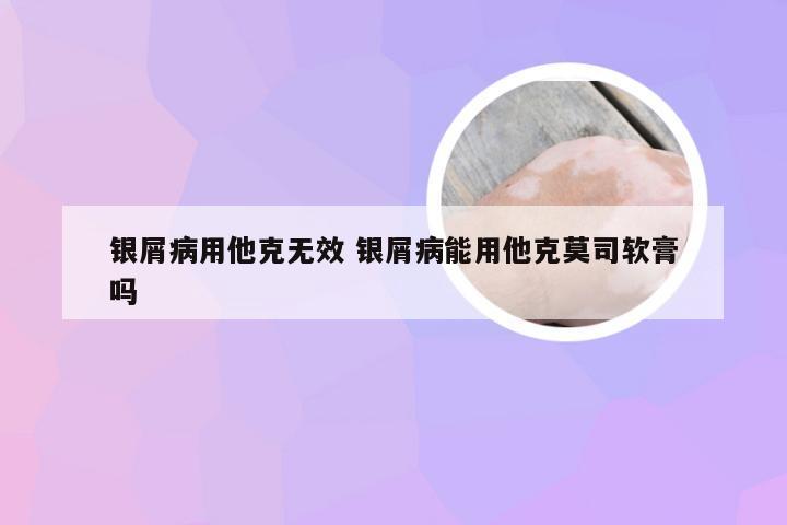 银屑病用他克无效 银屑病能用他克莫司软膏吗