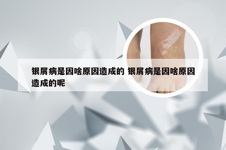 银屑病是因啥原因造成的 银屑病是因啥原因造成的呢