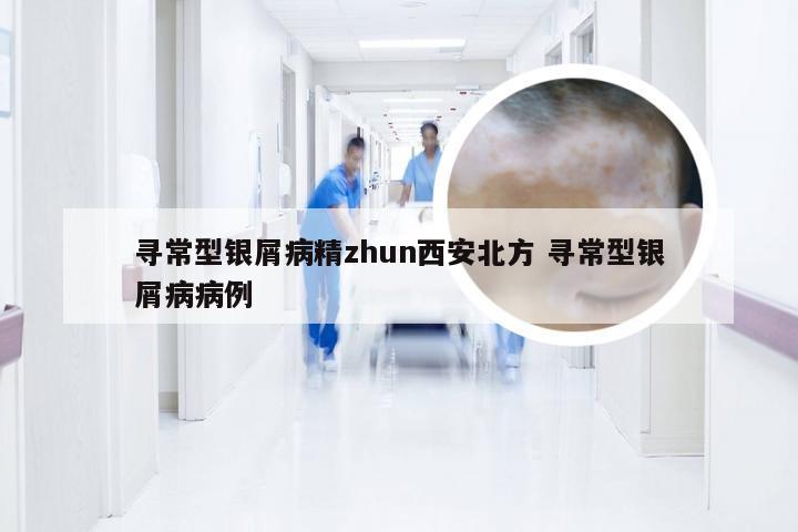寻常型银屑病精zhun西安北方 寻常型银屑病病例
