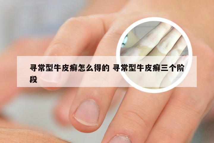 寻常型牛皮癣怎么得的 寻常型牛皮癣三个阶段