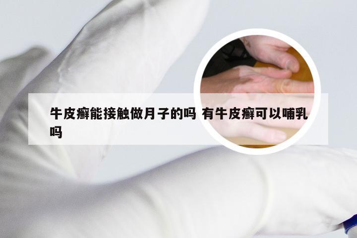 牛皮癣能接触做月子的吗 有牛皮癣可以哺乳吗