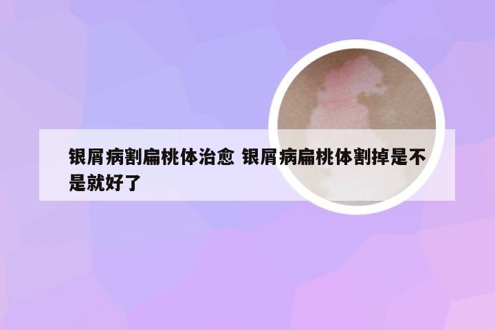 银屑病割扁桃体治愈 银屑病扁桃体割掉是不是就好了