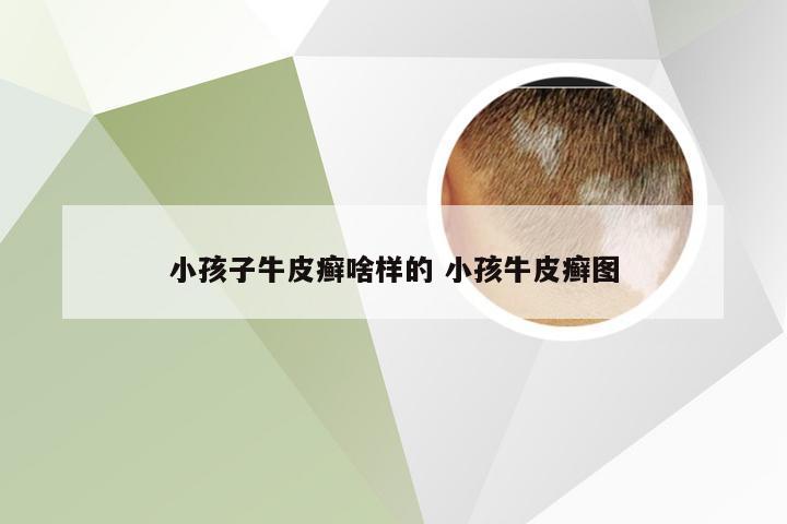 小孩子牛皮癣啥样的 小孩牛皮癣图