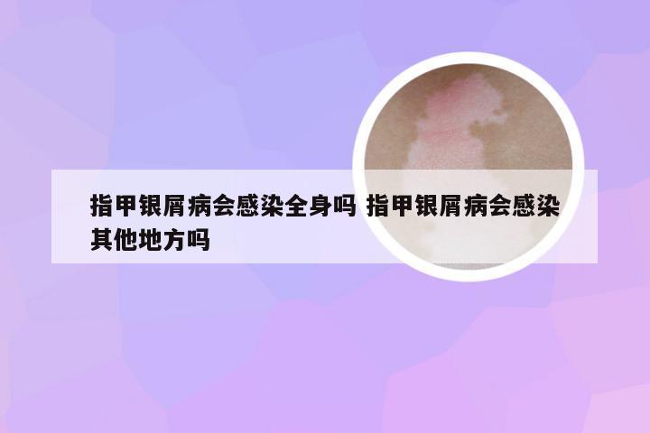 指甲银屑病会感染全身吗 指甲银屑病会感染其他地方吗