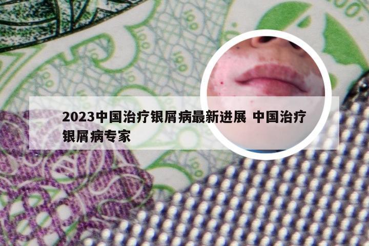 2023中国治疗银屑病最新进展 中国治疗银屑病专家