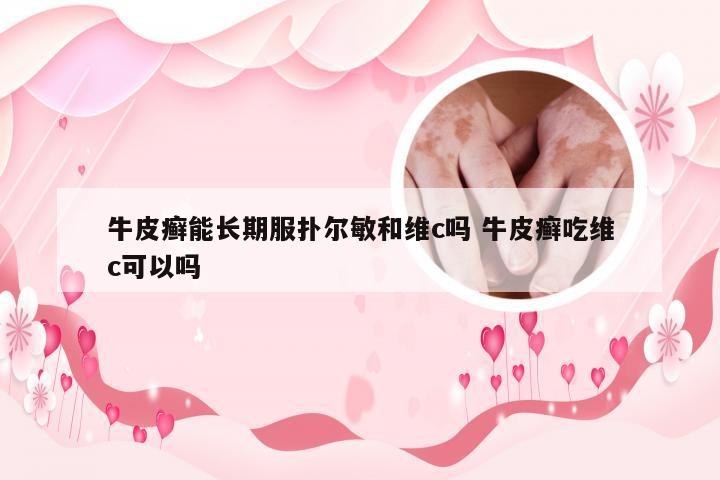 牛皮癣能长期服扑尔敏和维c吗 牛皮癣吃维c可以吗