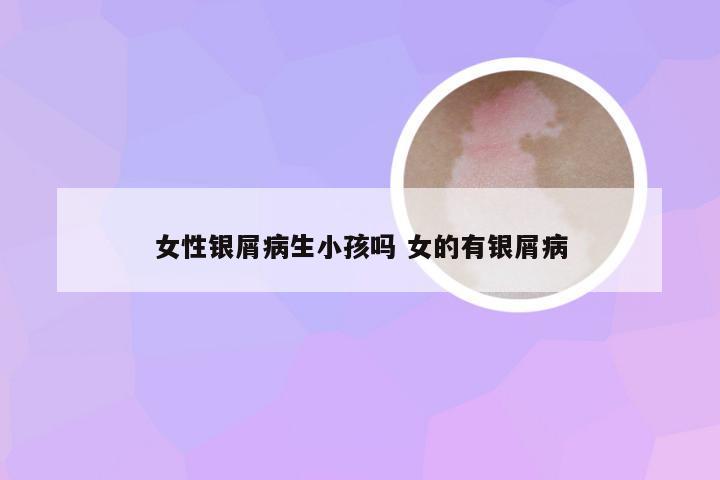 女性银屑病生小孩吗 女的有银屑病