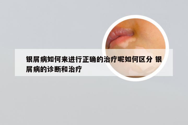 银屑病如何来进行正确的治疗呢如何区分 银屑病的诊断和治疗