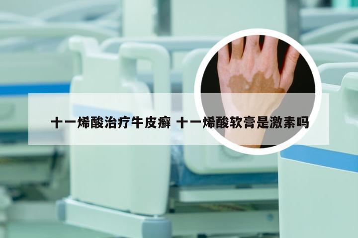 十一烯酸治疗牛皮癣 十一烯酸软膏是激素吗