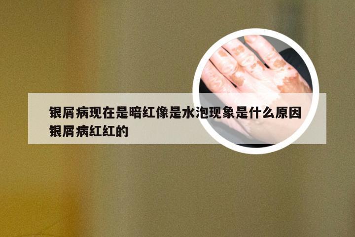 银屑病现在是暗红像是水泡现象是什么原因 银屑病红红的
