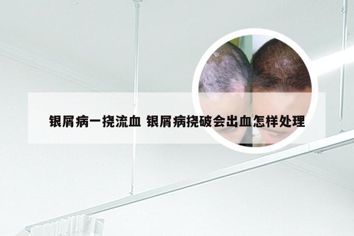 银屑病一挠流血 银屑病挠破会出血怎样处理