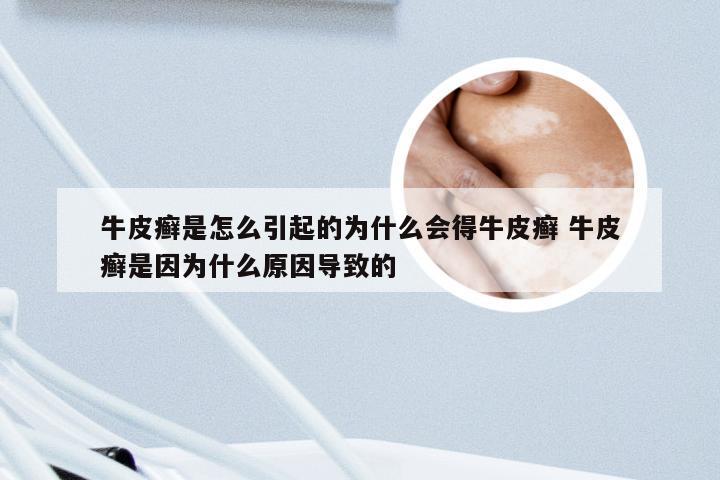 牛皮癣是怎么引起的为什么会得牛皮癣 牛皮癣是因为什么原因导致的