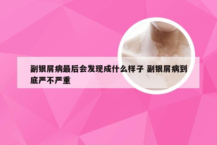 副银屑病最后会发现成什么样子 副银屑病到底严不严重