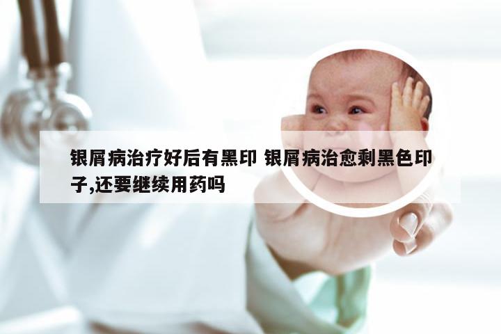 银屑病治疗好后有黑印 银屑病治愈剩黑色印子,还要继续用药吗