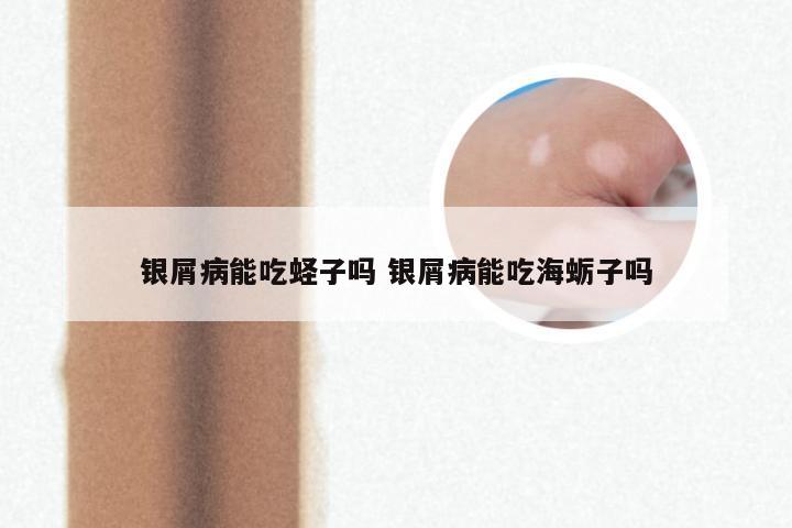 银屑病能吃蛏子吗 银屑病能吃海蛎子吗
