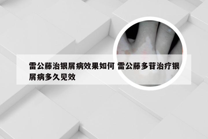 雷公藤治银屑病效果如何 雷公藤多苷治疗银屑病多久见效