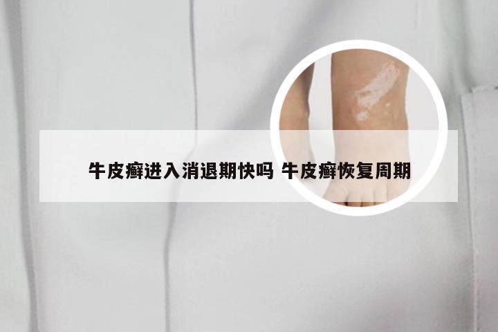 牛皮癣进入消退期快吗 牛皮癣恢复周期