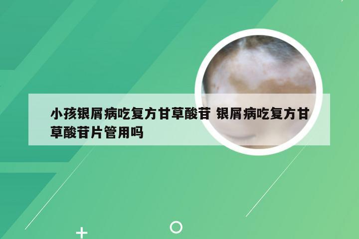 小孩银屑病吃复方甘草酸苷 银屑病吃复方甘草酸苷片管用吗
