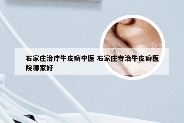 石家庄治疗牛皮癣中医 石家庄专治牛皮癣医院哪家好