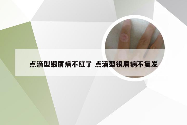 点滴型银屑病不红了 点滴型银屑病不复发