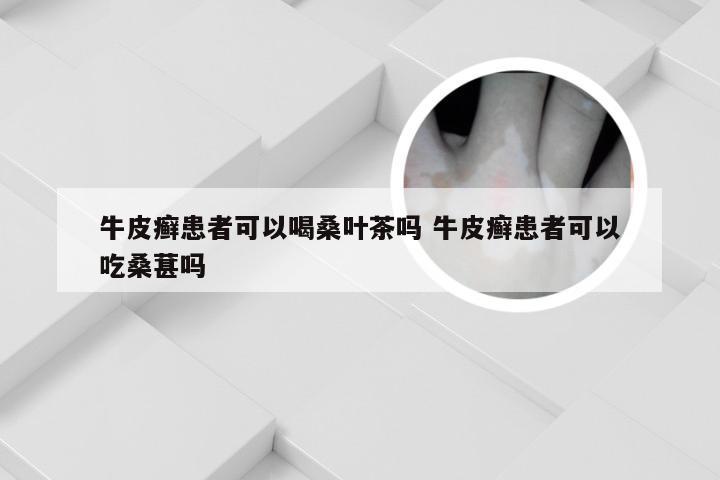 牛皮癣患者可以喝桑叶茶吗 牛皮癣患者可以吃桑葚吗