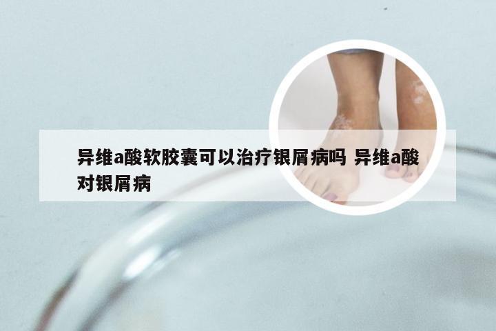 异维a酸软胶囊可以治疗银屑病吗 异维a酸对银屑病