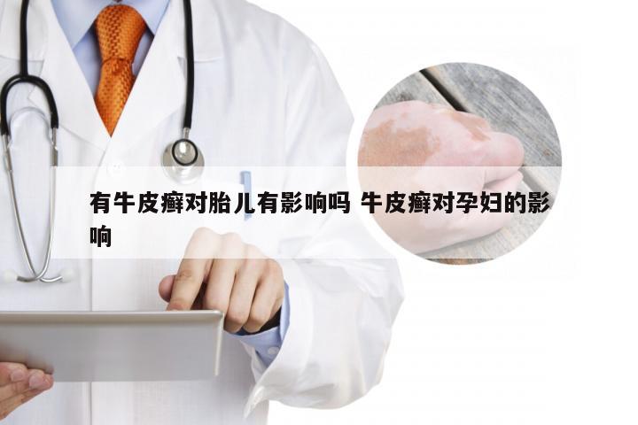 有牛皮癣对胎儿有影响吗 牛皮癣对孕妇的影响