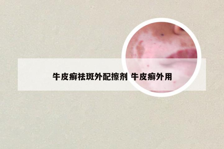 牛皮癣祛斑外配擦剂 牛皮癣外用