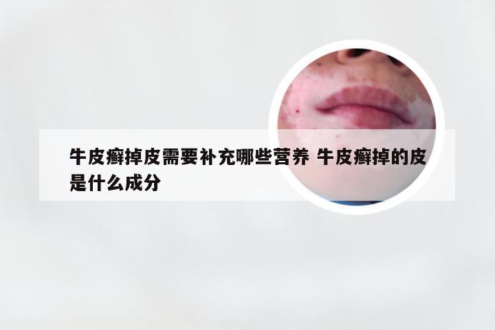 牛皮癣掉皮需要补充哪些营养 牛皮癣掉的皮是什么成分
